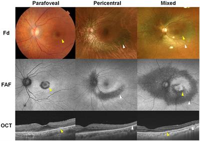 Novel imaging techniques for hydroxychloroquine retinopathy